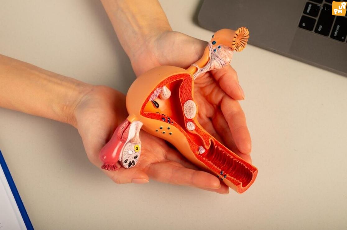 با این درمان خانگی از شر تنبلی تخمدان خلاص شوید با این درمان خانگی از شر تنبلی تخمدان خلاص شوید