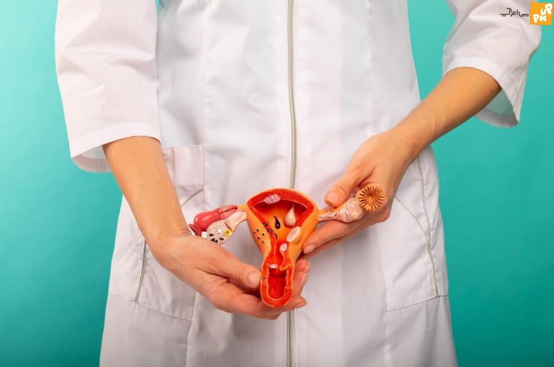 با این درمان خانگی از شر تنبلی تخمدان خلاص شوید با این درمان خانگی از شر تنبلی تخمدان خلاص شوید