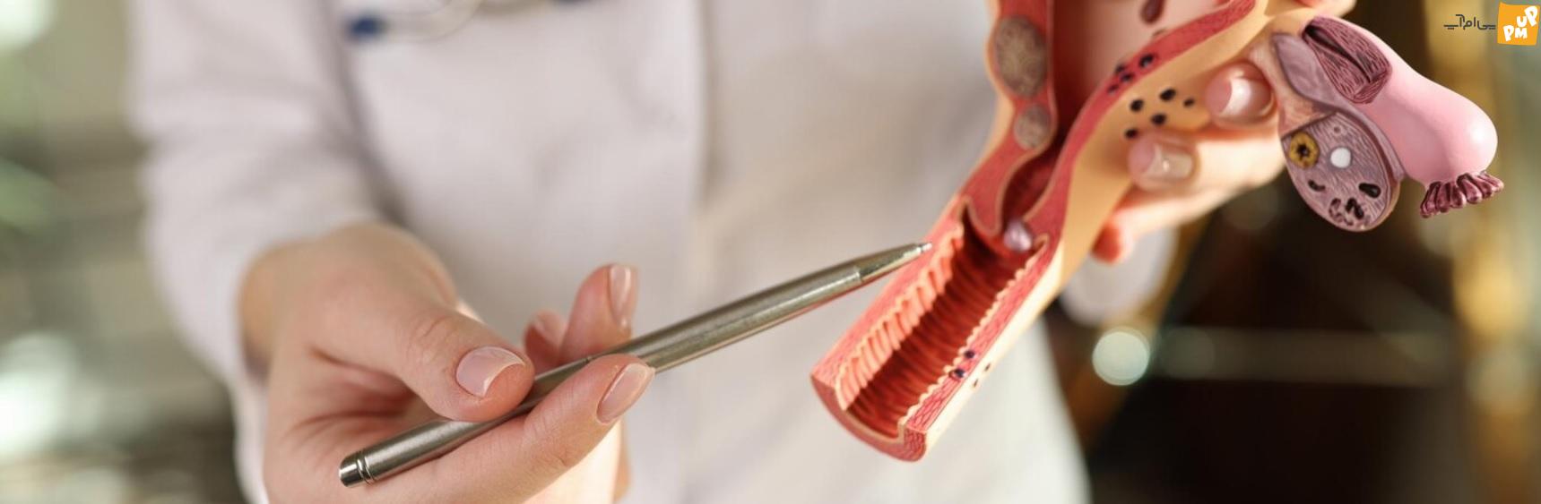 با این درمان خانگی از شر تنبلی تخمدان خلاص شوید با این درمان خانگی از شر تنبلی تخمدان خلاص شوید